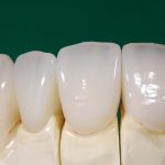 روکش تمام سرامیک، زیبایی بالاتر همراه با ملاحظه بیشتر