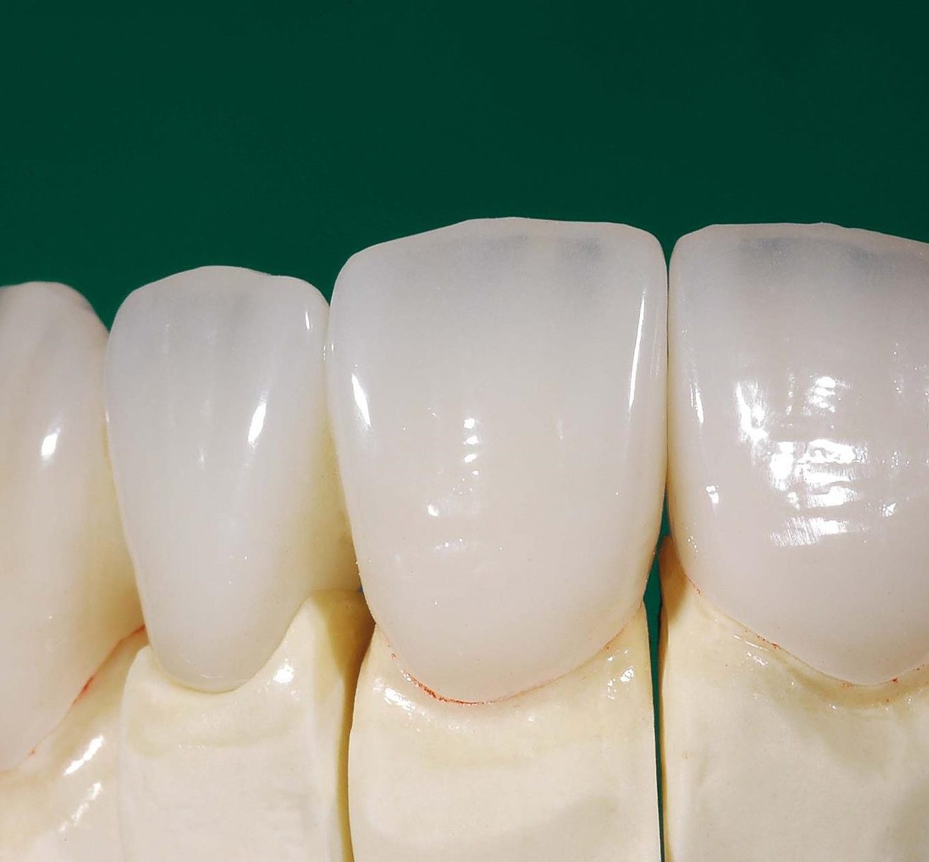 عکس روکش دندان تمام سرامیک