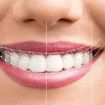 تمام آنچه که باید درباره اصلاح طرح لبخند بدانید