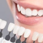 همه چیز درباره بلیچینگ دندان یا سفید کردن دندان + بررسی عوارض آن
