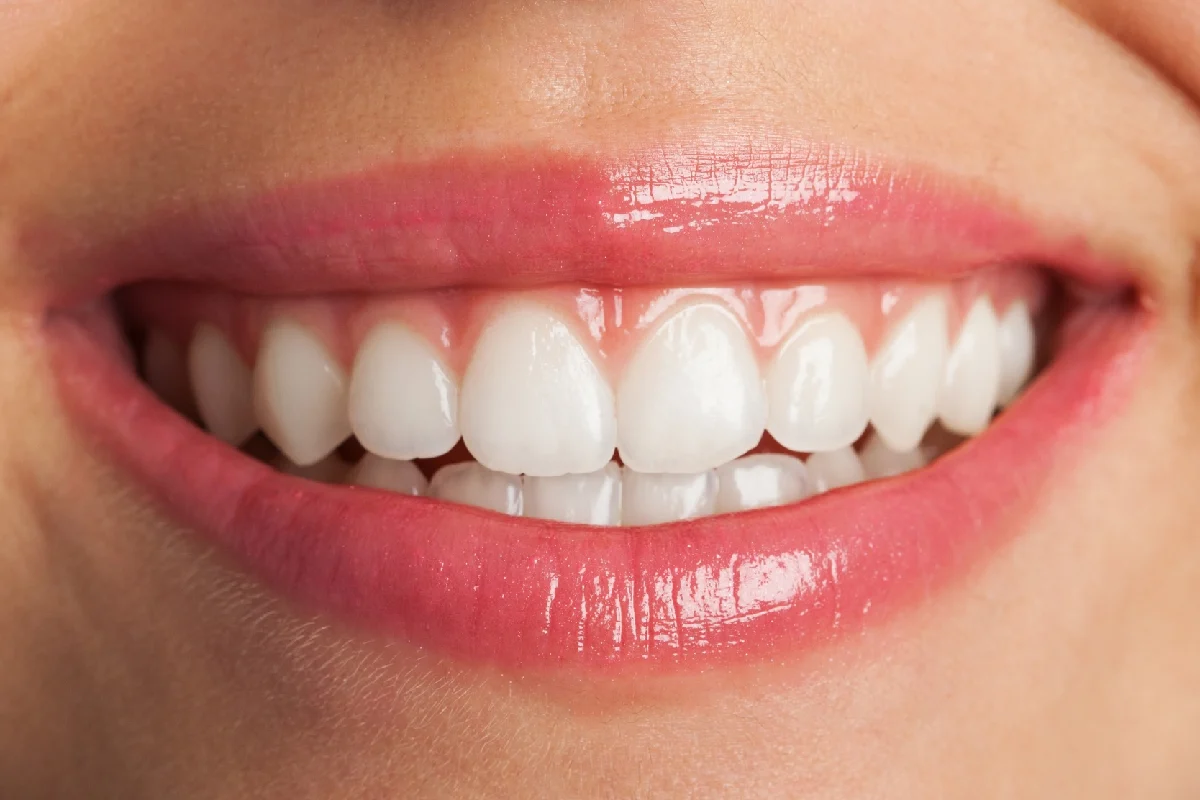 تفاوت بلیچینگ و جرمگیری دندان در چیست؟