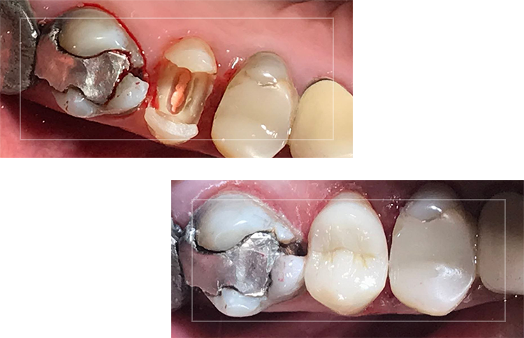 بستن فاصله بین دندانها BEFORE-AFTER-PICS-1-1.png