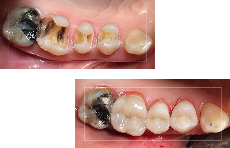 بستن فاصله بین دندانها BEFORE-AFTER-PICS.png